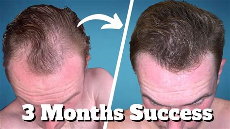 It offers oral finasteride, topical minoxidil, and a pack of both . . Topical dutasteride results